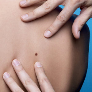 Präventionskampagne - Skincheck Aufklärung von Hautkrebs